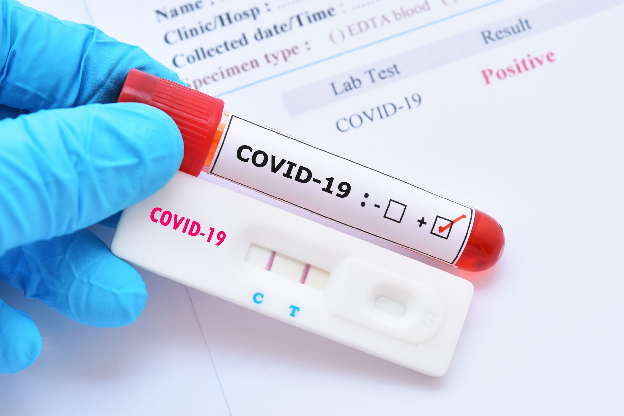 Testy na koronawirusa – dostępne rodzaje, zasady działania