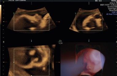 3 badanie prenatalne 2 III badanie prenatalne - robić, czy nie robić?