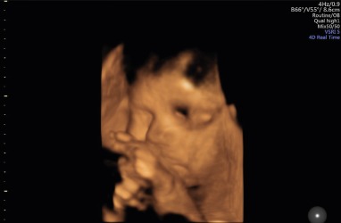 3 badanie prenatalne 4 III badanie prenatalne - robić, czy nie robić?