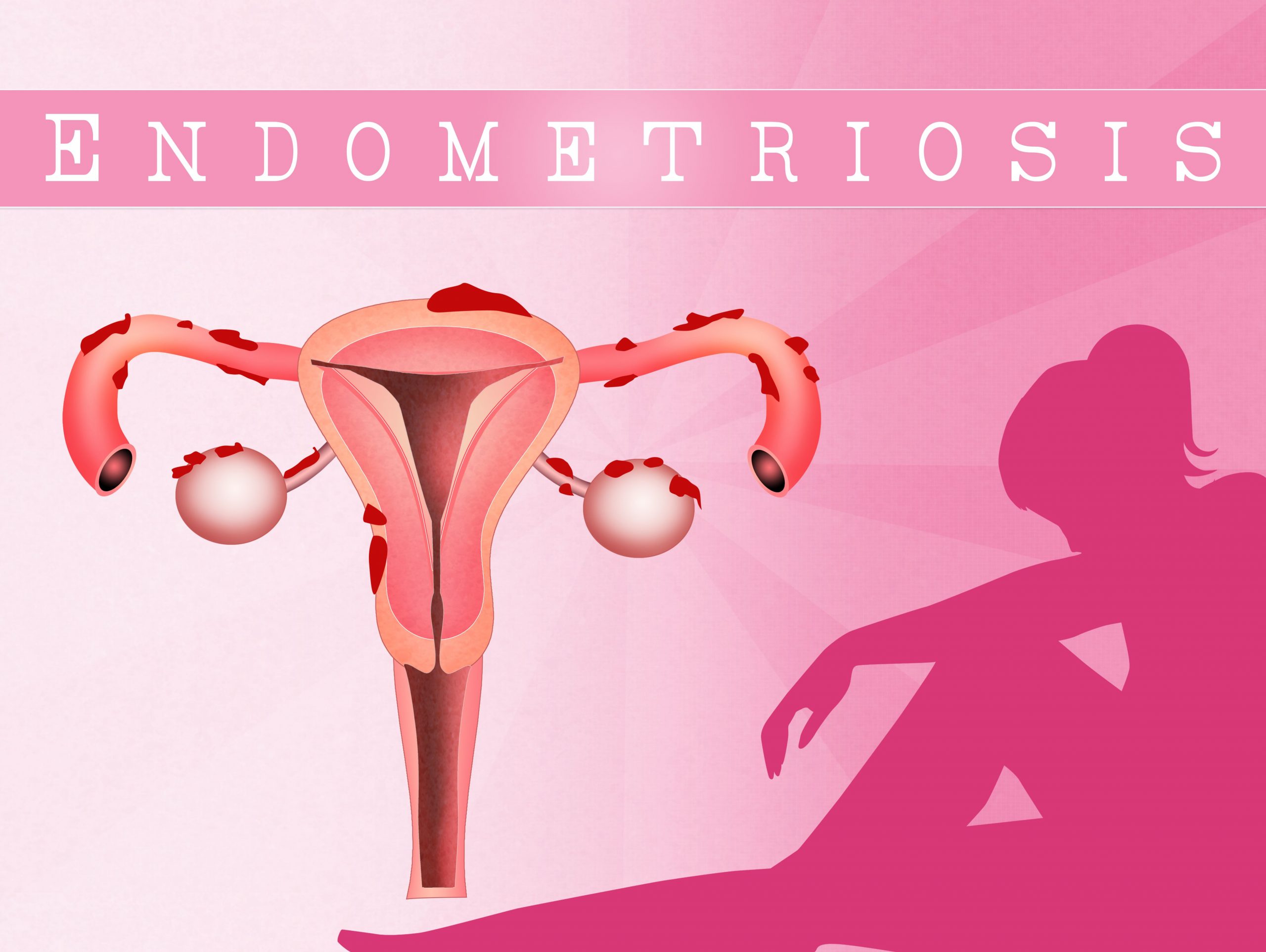 Ogniska endometriozy – zmora kobiet!