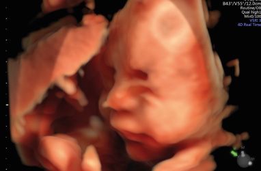 badanie prenatalne 2 III badanie prenatalne - robić, czy nie robić?