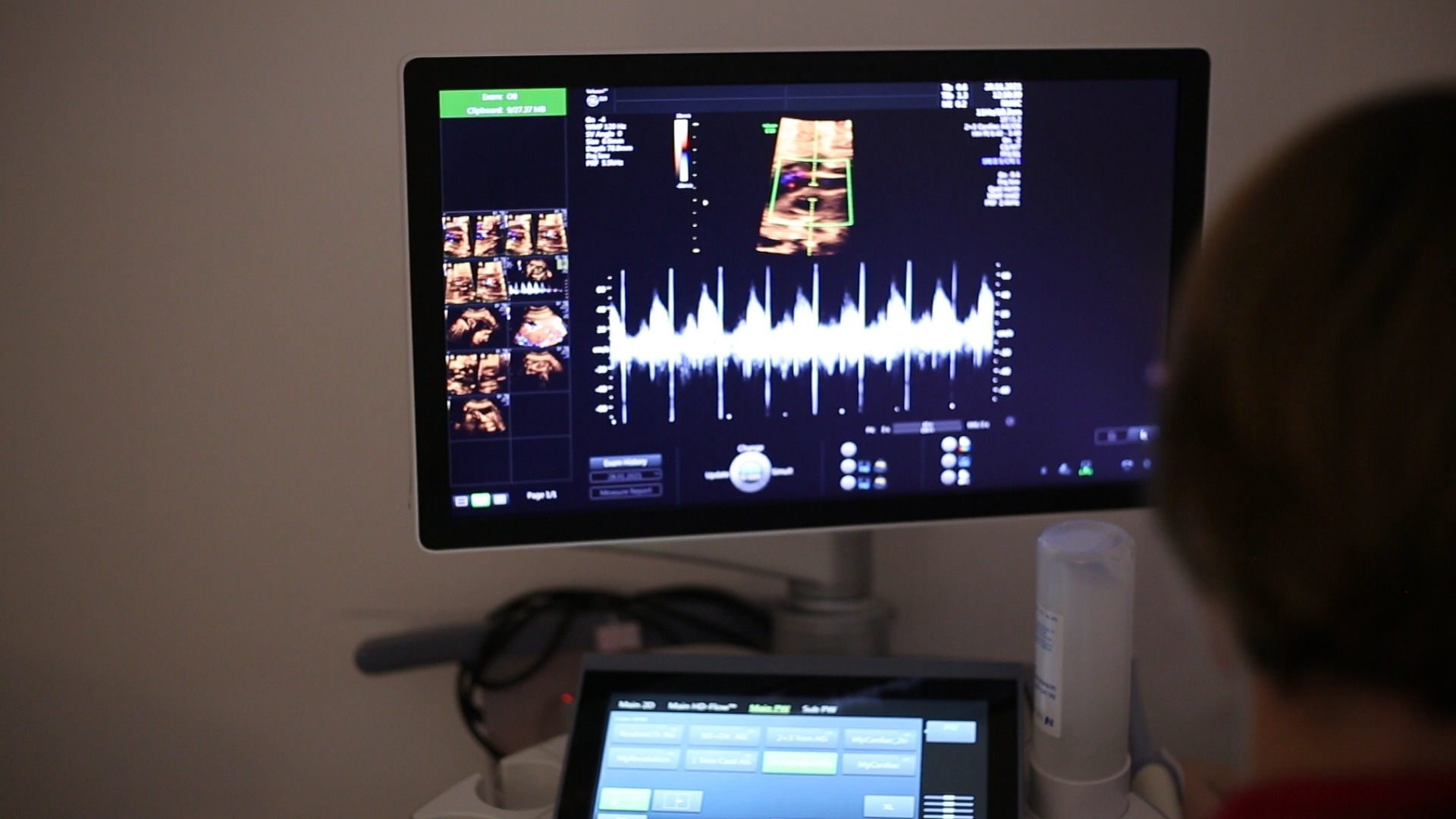 MINIATURKI YOUTBUE 34 Badania prenatalne - Refundacja badań prenatalnych